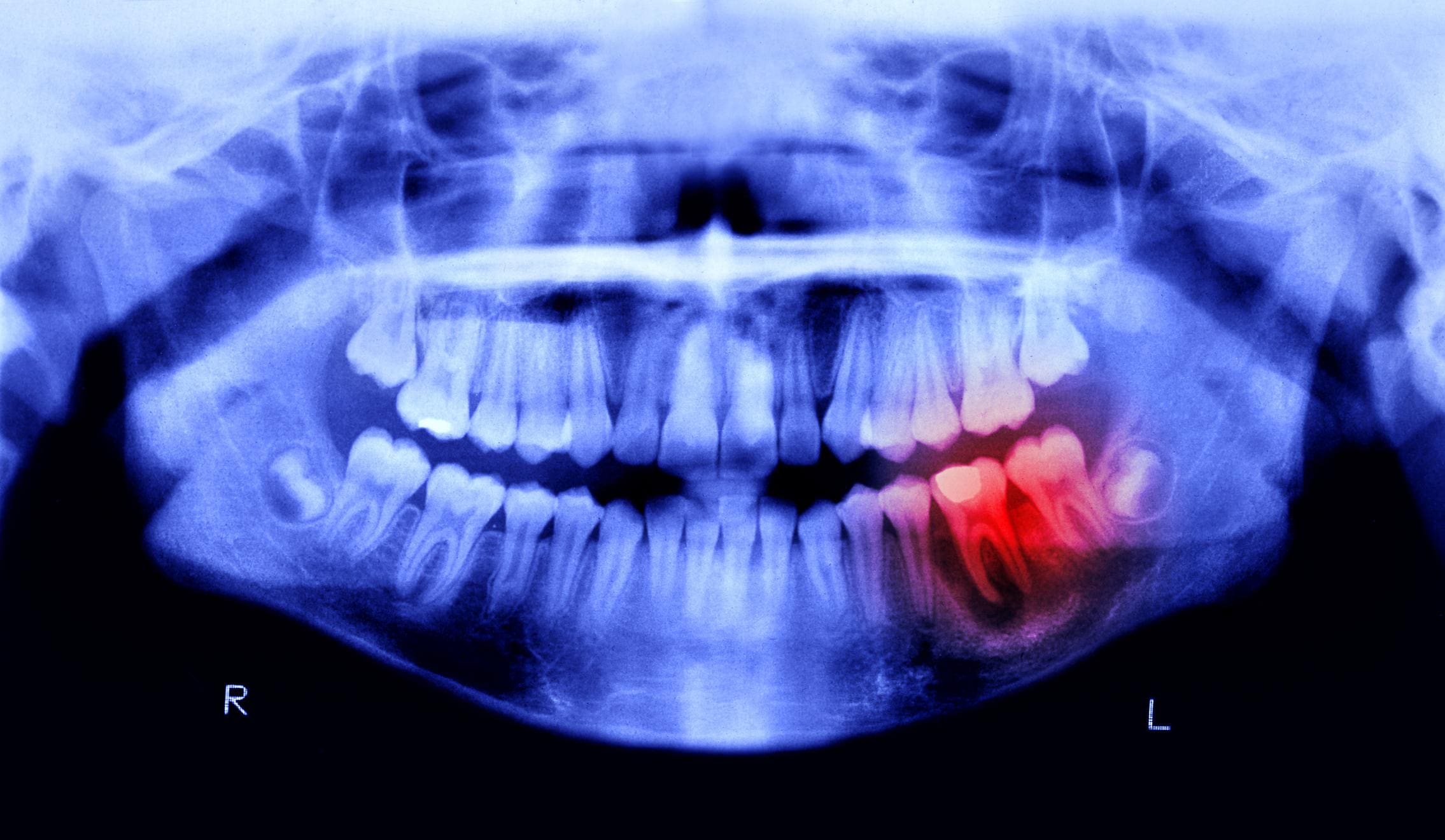 Ból zębów